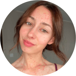 Claire Elizabeth lives with psoriasis